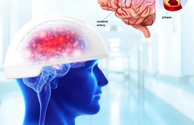 کلاه درمانی آلزایمر